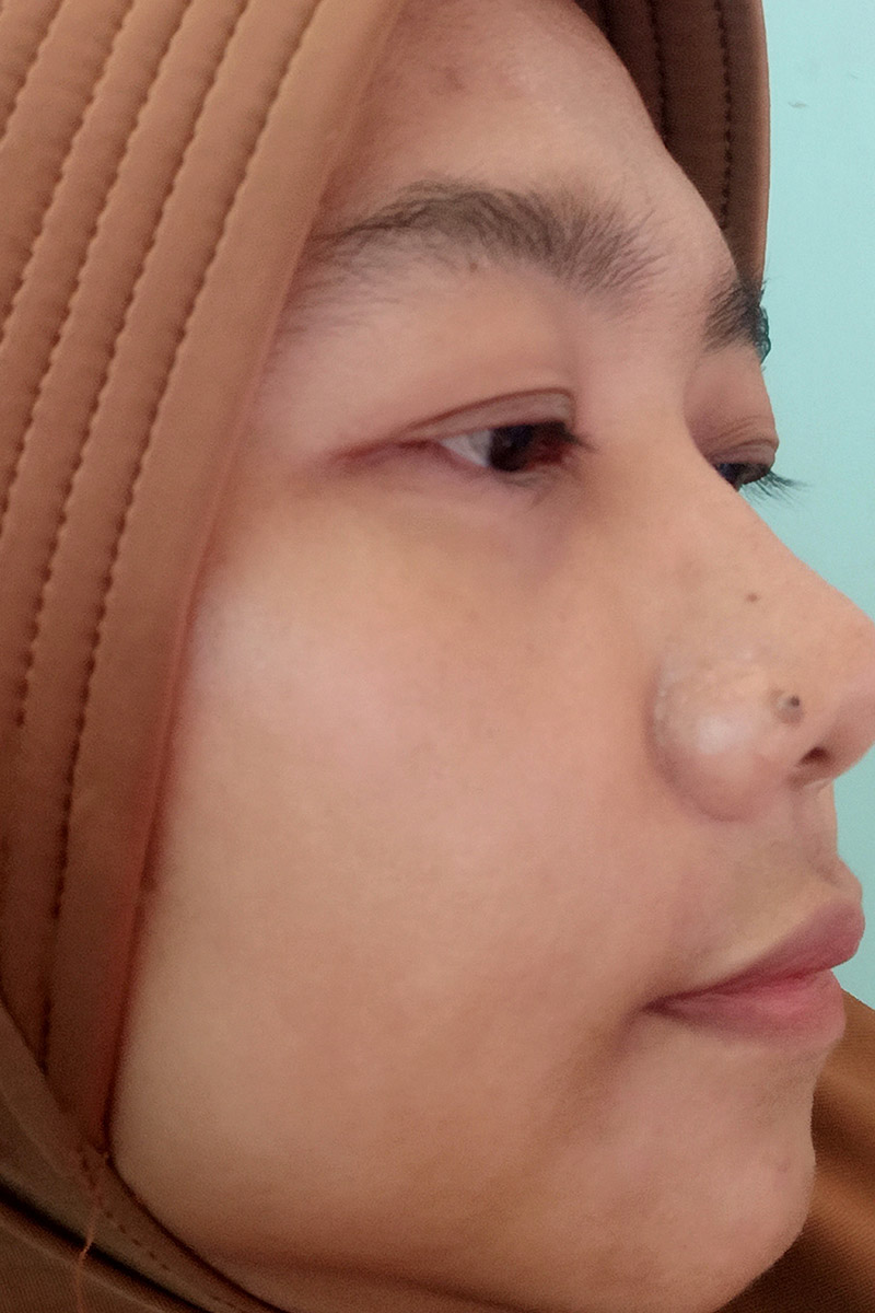 Before
